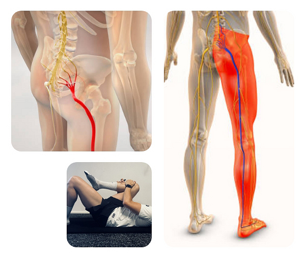 Solutions pour soulager la sciatique
